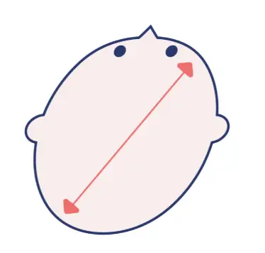 斜頭症（しゃとうしょう）のイメージ画像