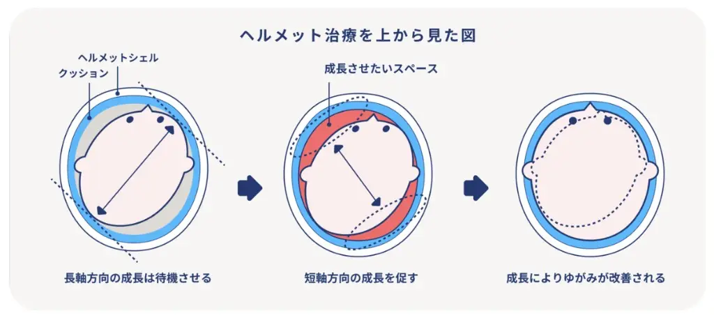 長頭症（ちょうとうしょう）のイメージ画像