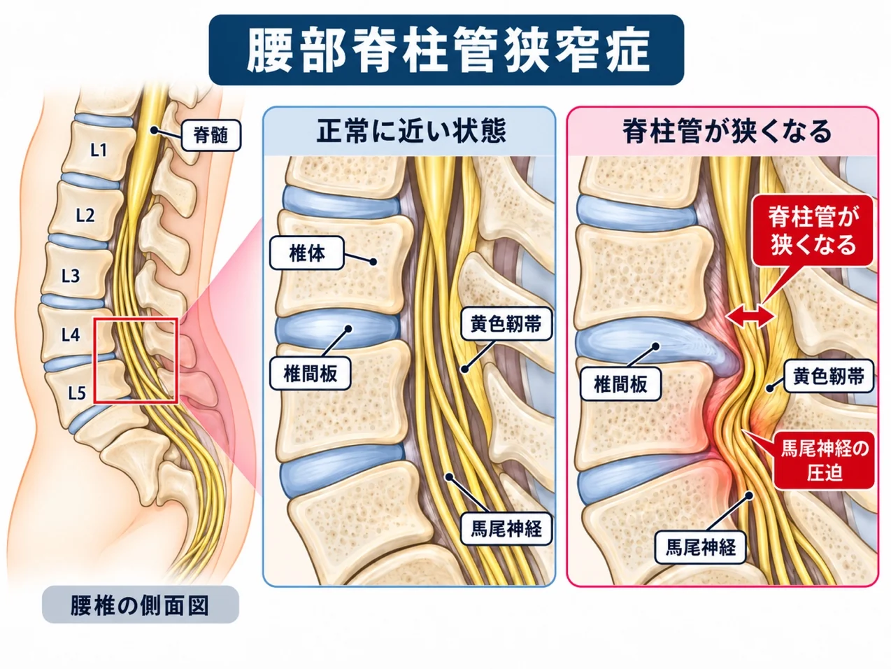 腰部脊柱管狭窄症の図解：正常に近い状態と、脊柱管が狭くなり馬尾神経が圧迫された状態