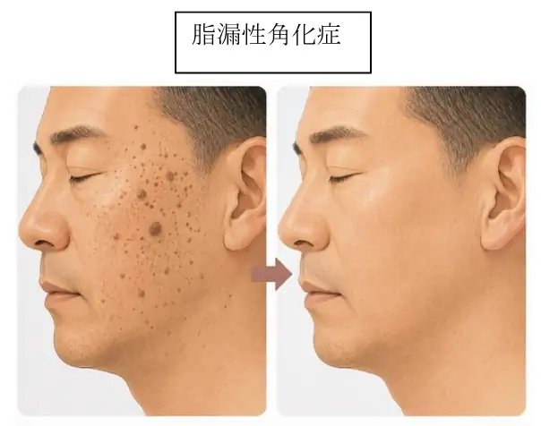 脂漏性角化症の治療ビフォーアフター