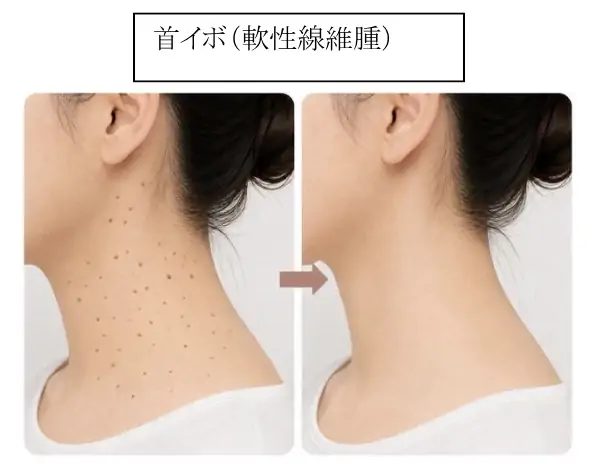 首イボ（軟性線維腫）の治療ビフォーアフター